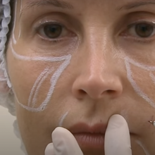 Technika zabiegów na twarz z kaniulą SOFTFIL® PRECISION