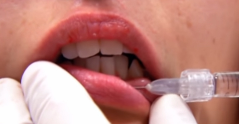 Kształtowanie ust kwasem hialuronowym - dr Wojciech Marusza