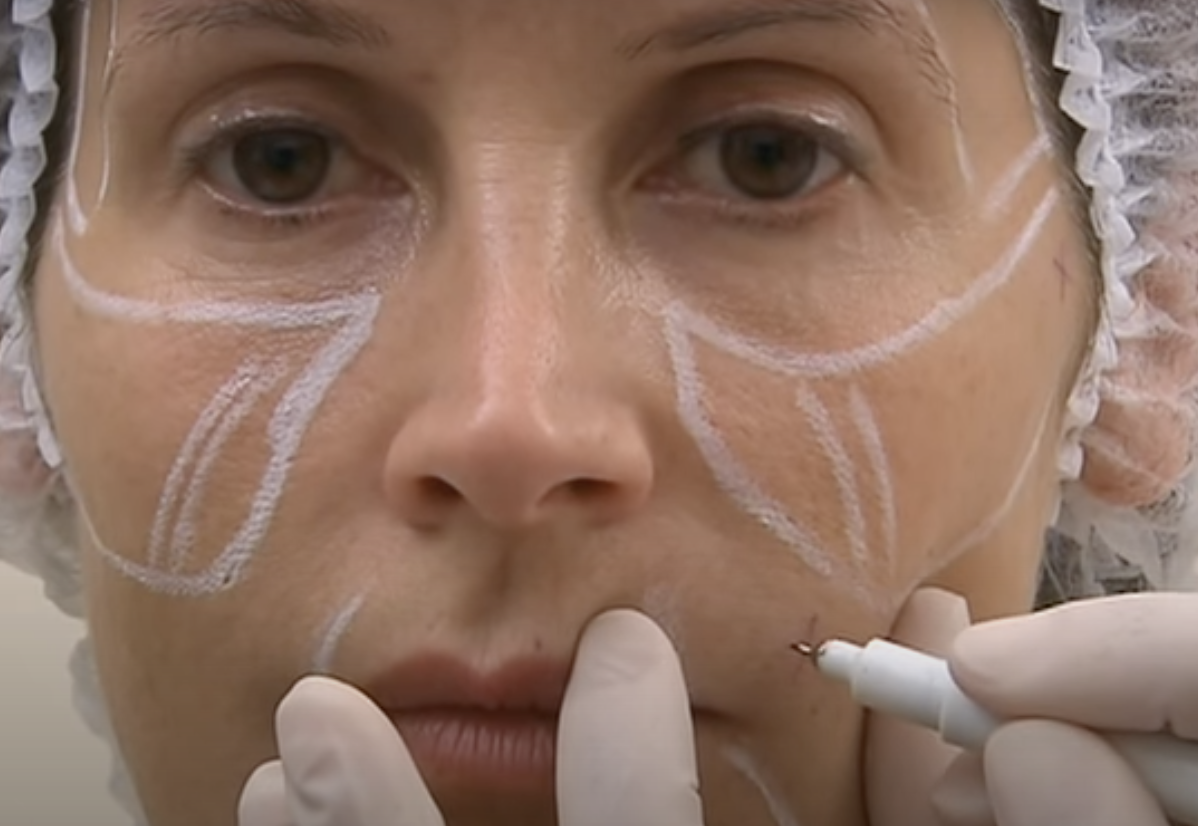 Technika zabiegów na twarz z kaniulą SOFTFIL® PRECISION