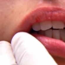 Kształtowanie ust kwasem hialuronowym - dr Wojciech Marusza