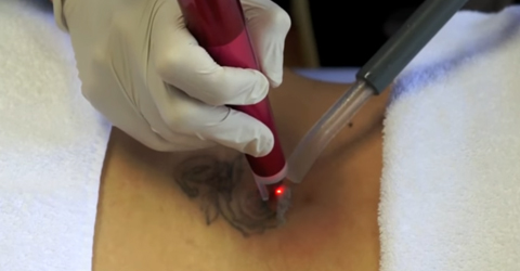 Znieczulenie ZCryo 6 podczas usuwania tatuażu